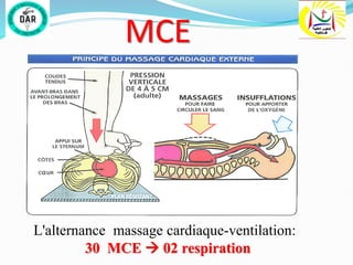 MCE
L'alternance massage cardiaque-ventilation:
30 MCE  02 respiration
 