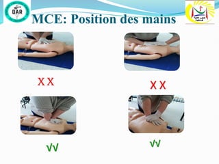 MCE: Position des mains
X X X X
√√ √√
 