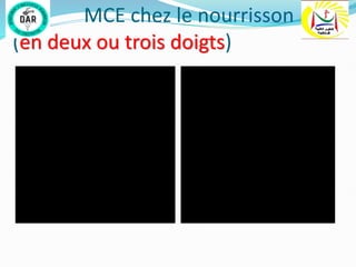 MCE chez le nourrisson
(en deux ou trois doigts)
 