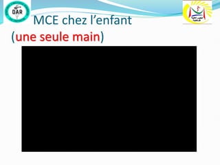 MCE chez l’enfant
(une seule main)
 