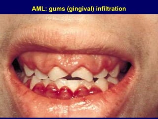 AML: gums (gingival) infiltration
 
