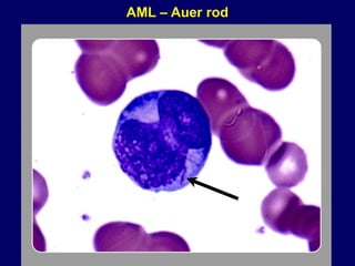 AML – Auer rod
 