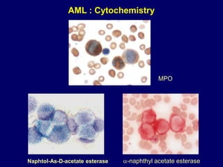 MPO
Naphtol-As-D-acetate esterase -naphthyl acetate esterase
AML : Cytochemistry
 