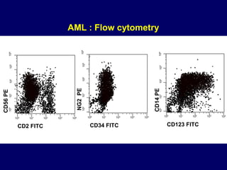 CD56
PE
100 101 102 103 104
CD2 FITC
10
0
10
1
10
2
10
3
10
4
NG2
PE
100 101 102 103 104
CD34 FITC
10
0
10
1
10
2
10
3
10
4
CD14
PE
100 101 102 103
104
CD123 FITC
10
0
10
1
10
2
10
3
10
4
AML : Flow cytometry
 