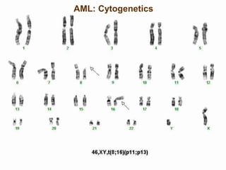AML: Cytogenetics
 