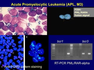 Acute Promyelocytic Leukemia (APL, M3)
bcr1 bcr3
RT-PCR PML/RAR-alpha
FISH:
PML/RARA
fusion signal
Anti-PGM3 pattern staining
 