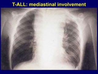T-ALL: mediastinal involvement
 