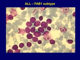ALL – FAB1 subtype
 