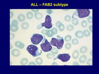 ALL – FAB2 subtype
 