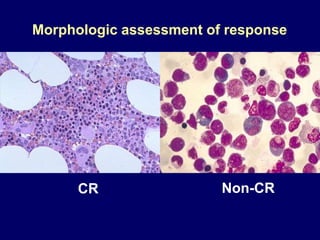 Morphologic assessment of response
CR Non-CR
 