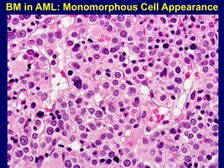 BM in AML: Monomorphous Cell Appearance
 