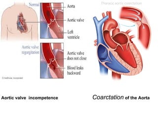 Aortic valve incompetence Coarctation of the Aorta
 