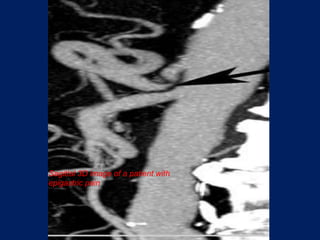  angulations and narrowing of the proximal celiac axis. Sagittal 3D image of a patient with epigastric pain  