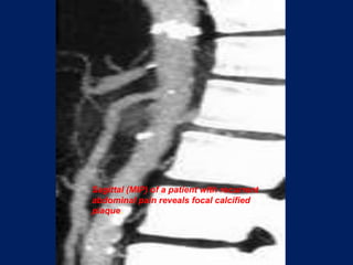 Sagittal (MIP) of a patient with recurrent abdominal pain reveals focal calcified plaque.