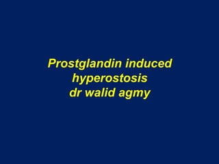 Prostglandin induced hyperostosisdrwalidagmy