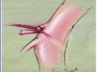 in some people, the ligament inserts low or celiac art originate high.