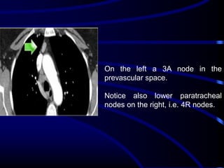 On the left a 3A node in the
prevascular space.

Notice also lower paratracheal
nodes on the right, i.e. 4R nodes.

 