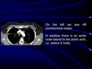 On the left we see
paratracheal nodes.

4R

In addition there is an aortic
node lateral to the aortic arch,
i.e. station 6 node.

 