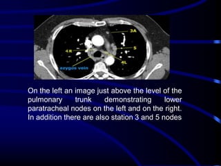 On the left an image just above the level of the
pulmonary
trunk
demonstrating
lower
paratracheal nodes on the left and on the right.
In addition there are also station 3 and 5 nodes

 