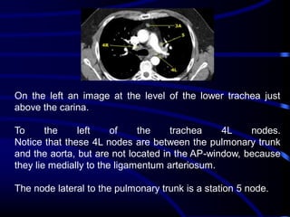 On the left an image at the level of the lower trachea just
above the carina.
To
the
left
of
the
trachea
4L
nodes.
Notice that these 4L nodes are between the pulmonary trunk
and the aorta, but are not located in the AP-window, because
they lie medially to the ligamentum arteriosum.
The node lateral to the pulmonary trunk is a station 5 node.

 