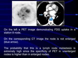 On the left a PET image demonstrating FDG uptake in a
station 8 node.
On the corresponding CT image the node is not enlarged
(blue arrow).
The probability that this is a lymph node metastasis is
extremely high since the specificity of PET in unenlarged
nodes is higher than in enlarged nodes.

 
