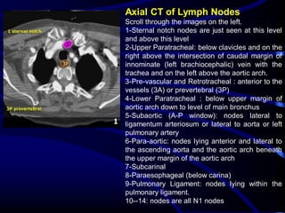 Axial CT of Lymph Nodes
•

Scroll through the images on the left.
1-Sternal notch nodes are just seen at this level
and above this level
2-Upper Paratracheal: below clavicles and on the
right above the intersection of caudal margin of
innominate (left brachiocephalic) vein with the
trachea and on the left above the aortic arch.
3-Pre-vascular and Retrotracheal : anterior to the
vessels (3A) or prevertebral (3P)
4-Lower Paratracheal : below upper margin of
aortic arch down to level of main bronchus
5-Subaortic (A-P window): nodes lateral to
ligamentum arteriosum or lateral to aorta or left
pulmonary artery
6-Para-aortic: nodes lying anterior and lateral to
the ascending aorta and the aortic arch beneath
the upper margin of the aortic arch
7-Subcarinal
8-Paraesophageal (below carina)
9-Pulmonary Ligament: nodes lying within the
pulmonary ligament.
10--14: nodes are all N1 nodes

 