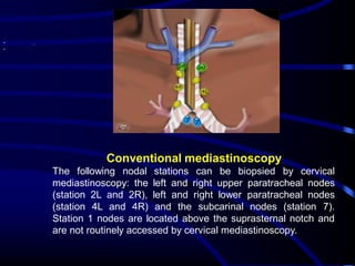 •
•

Conventional mediastinoscopy
The following nodal stations can be biopsied by cervical
mediastinoscopy: the left and right upper paratracheal nodes
(station 2L and 2R), left and right lower paratracheal nodes
(station 4L and 4R) and the subcarinal nodes (station 7).
Station 1 nodes are located above the suprasternal notch and
are not routinely accessed by cervical mediastinoscopy.

 