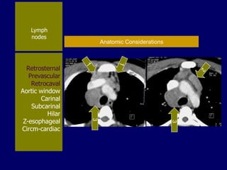 Lymph
nodes

3

3

Retrosternal
Prevascular
Retrocaval
Aortic window
Carinal
Subcarinal
Hilar
Z-esophageal
Circm-cardiac

Anatomic Considerations

 