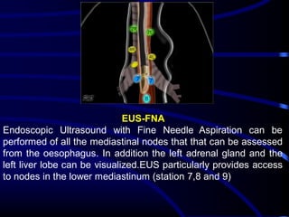 EUS-FNA
Endoscopic Ultrasound with Fine Needle Aspiration can be
performed of all the mediastinal nodes that that can be assessed
from the oesophagus. In addition the left adrenal gland and the
left liver lobe can be visualized.EUS particularly provides access
to nodes in the lower mediastinum (station 7,8 and 9)

 