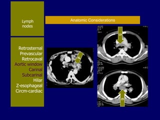 Lymph
nodes

Anatomic Considerations

5

Retrosternal
Prevascular
Retrocaval
Aortic window
Carinal
Subcarinal
Hilar
Z-esophageal
Circm-cardiac
6

 