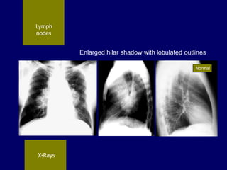 Lymph
nodes

Enlarged hilar shadow with lobulated outlines
Normal

X-Rays

 