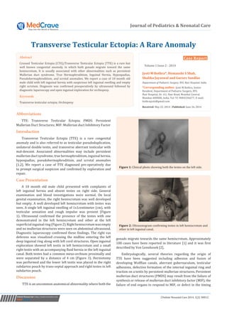 J Pediatr Neonatal Care 2014, 1(2): 00012Submit Manuscript | http://medcraveonline.com
Journal of Pediatrics & Neonatal Care
Transverse Testicular Ectopia: A Rare Anomaly
Case Report
Volume 1 Issue 2 - 2014
Jyoti M Bothra*, Hemanshi S Shah,
Shalika Jayaswal and Gursev Sandlas
Department of Pediatric Surgery, BYL Nair Hospital, India
*Corresponding author: Jyoti M Bothra, Senior
Resident, Department of Pediatric Surgery, BYL
Nair Hospital, Dr. A.L. Nair Road, Mumbai Central,
Mumbai-400008, India, Tel: 91-9004336677; E-mail:
bothrajyoti@gmail.com
Received: May 22, 2014 | Published: June 26, 2014
Abbreviations
TTE: Transverse Testicular Ectopia; PMDS: Persistent
Mullerian Duct Structures; MIF: Mullerian duct Inhibitory Factor
Introduction
Transverse Testicular Ectopia (TTE) is a rare congenital
anomaly and is also referred to as testicular pseudoduplication,
unilateral double testis, and transverse aberrant testicular with
mal-descent. Associated abnormalities may include persistent
mullerian duct syndrome, true hermaphroditism, inguinal hernia,
hypospadias, pseudohermaphroditism, and scrotal anomalies
[1,2]. We report a case of TTE diagnosed pre-operatively due
to prompt surgical suspicion and confirmed by exploration and
repair.
Case Presentation
A 10 month old male child presented with complaints of
left inguinal hernia and absent testes on right side. General
examination and blood investigations were normal. On local
genital examination, the right hemiscrotum was well developed
but empty. A well developed left hemiscrotum with testes was
seen. A single left inguinal swelling of 1x1centimeter (cm), with
testicular sensation and cough impulse was present (Figure
1). Ultrasound confirmed the presence of the testes with one
demonstrated in the left hemiscrotum and other at the left
superficialinguinalring(Figure2).Righthemiscrotumwasempty
and no mullerian structures were seen on abdominal ultrasound.
Diagnostic laparoscopy confirmed these findings. The right vas
deferens was visualized crossing the midline entering the left
deep inguinal ring along with left cord structures. Open inguinal
exploration showed left testis in left hemiscrotum and a small
right testis with an accompanying fluid hernia in the left inguinal
canal. Both testes had a common meso-orchium proximally and
were separated by a distance of 4 cm (Figure 3). Herniotomy
was performed and the lower left testis was placed in the right
subdartos pouch by trans-septal approach and right testes in left
subdartos pouch.
Discussion
TTE is an uncommon anatomical abnormality where both the
gonads migrate towards the same hemiscrotum. Approximately
100 cases have been reported in literature [1] and it was first
described by Von Lennhosek [2].
Embryologically, several theories regarding the origin of
TTE have been suggested including adhesion and fusion of
developing Wolffian canals, aberrant gubernaculum, testicular
adhesions, defective formation of the internal inguinal ring and
traction on a testis by persistent mullerian structures. Persistent
mullerian duct structures (PMDS) may result from the failure of
synthesis or release of mullerian duct inhibitory factor (MIF), the
failure of end organs to respond to MIF, or defect in the timing
Abstract
Crossed Testicular Ectopia (CTE)/Transverse Testicular Ectopia (TTE) is a rare but
well known congenital anomaly, in which both gonads migrate toward the same
hemiscrotum. It is usually associated with other abnormalities such as persistent
Mullerian duct syndrome, True Hermaphroditism, Inguinal Hernia, Hypospadias,
Pseudohermaphroditism, and scrotal anomalies. We report a case of 10 month old
male child with left inguinal hernia with suspicious left inguinal swelling and empty
right scrotum. Diagnosis was confirmed preoperatively by ultrasound followed by
diagnostic laparoscopy and open inguinal exploration for orchiopexy.
Keywords
Transverse testicular ectopia; Orchiopexy
Figure 1: Clinical photo showing both the testes on the left side.
Figure 2: Ultrasonogram confirming testes in left hemiscrotum and
other in left inguinal canal.
 