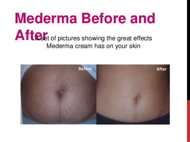 mederma before and after