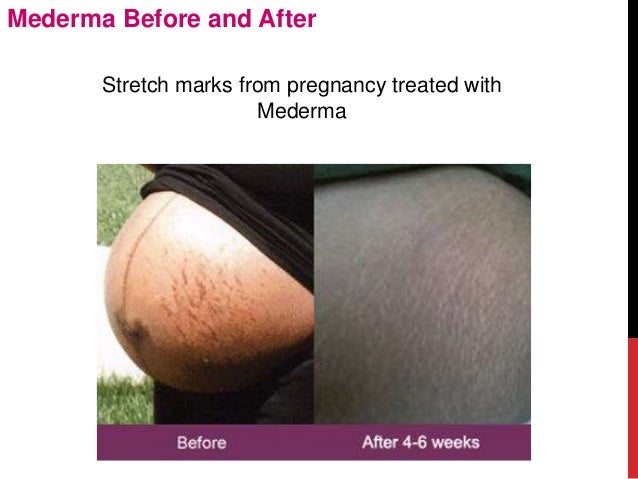 mederma before and after