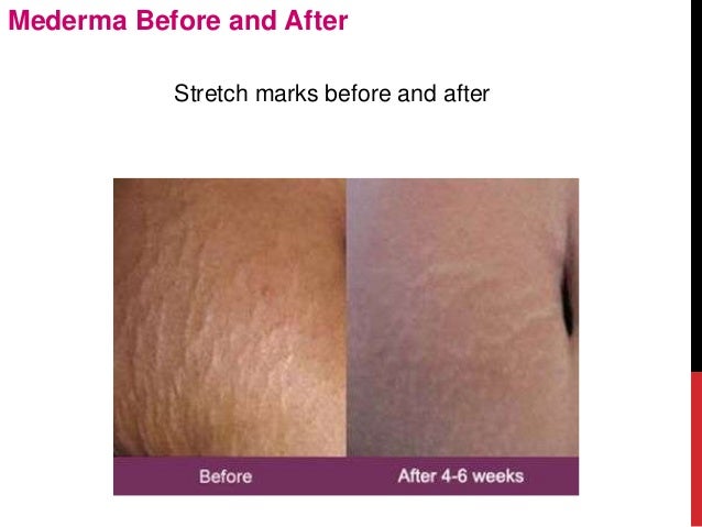 mederma before and after mederma before and after