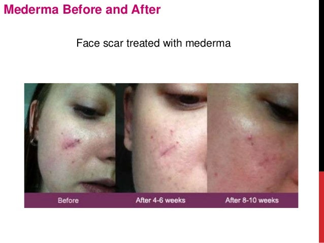 mederma before and after