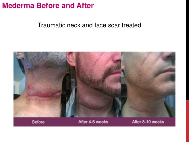 Mederma before-and-after