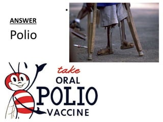 ANSWER
• Polio
Polio
 