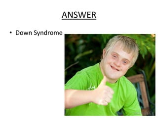 ANSWER
• Down Syndrome
 
