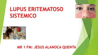 LUPUS ERITEMATOSO
SISTEMICO
MR 1 FM: JESUS ALANOCA QUENTA
 