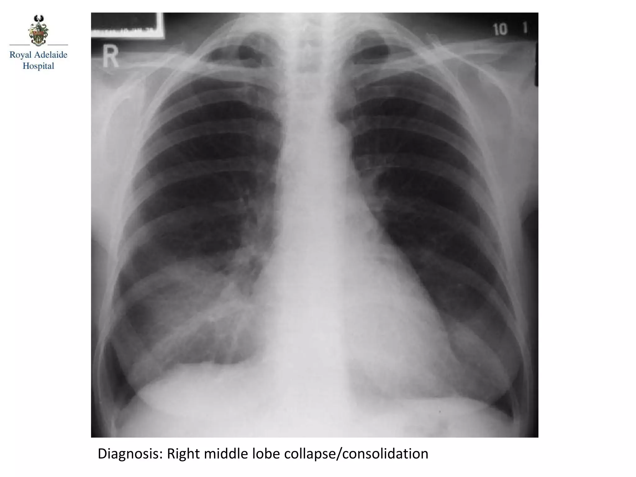 Diagnosis: Right middle lobe collapse/consolidation
 