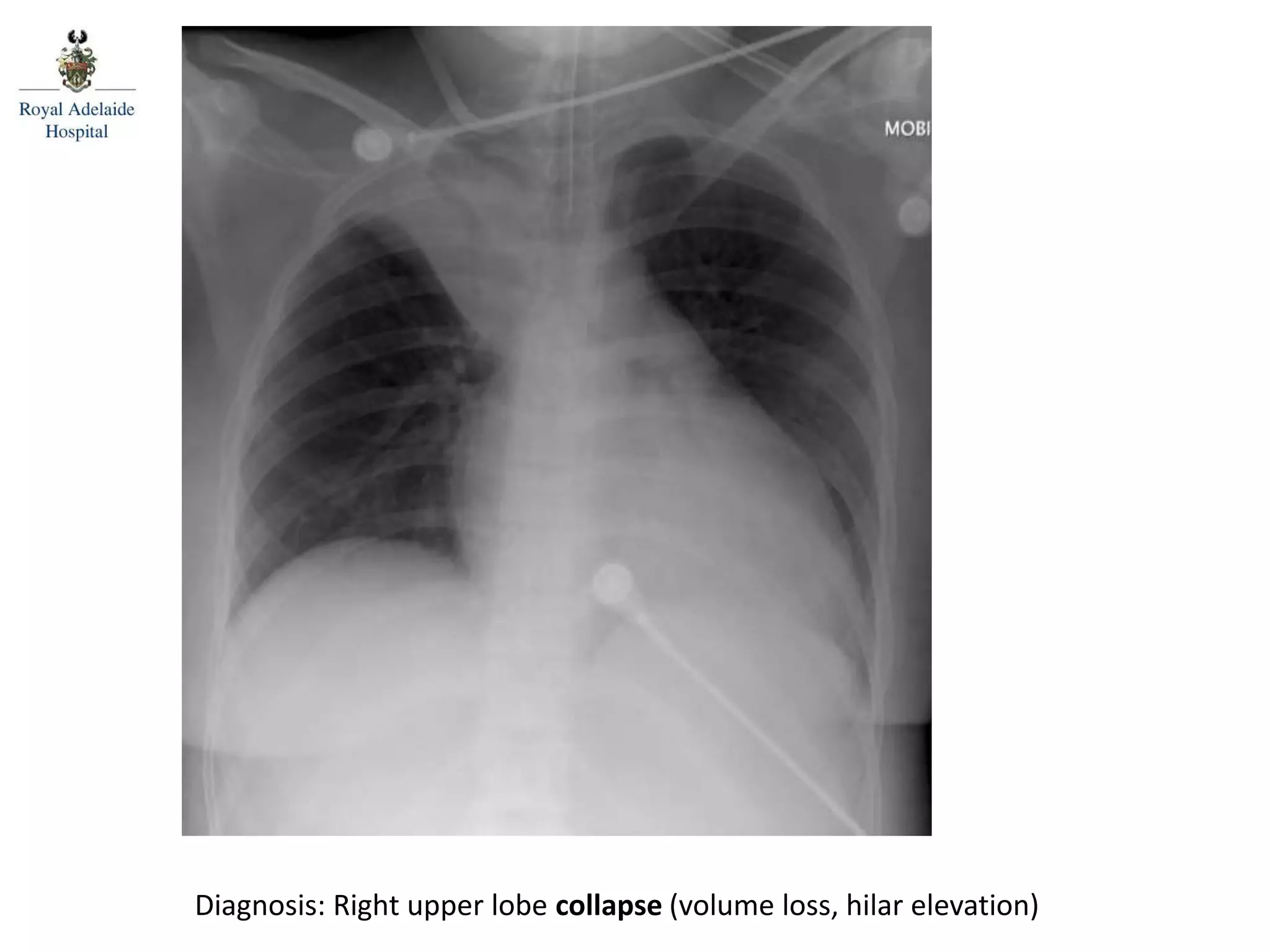 Diagnosis: Right upper lobe collapse (volume loss, hilar elevation)
 