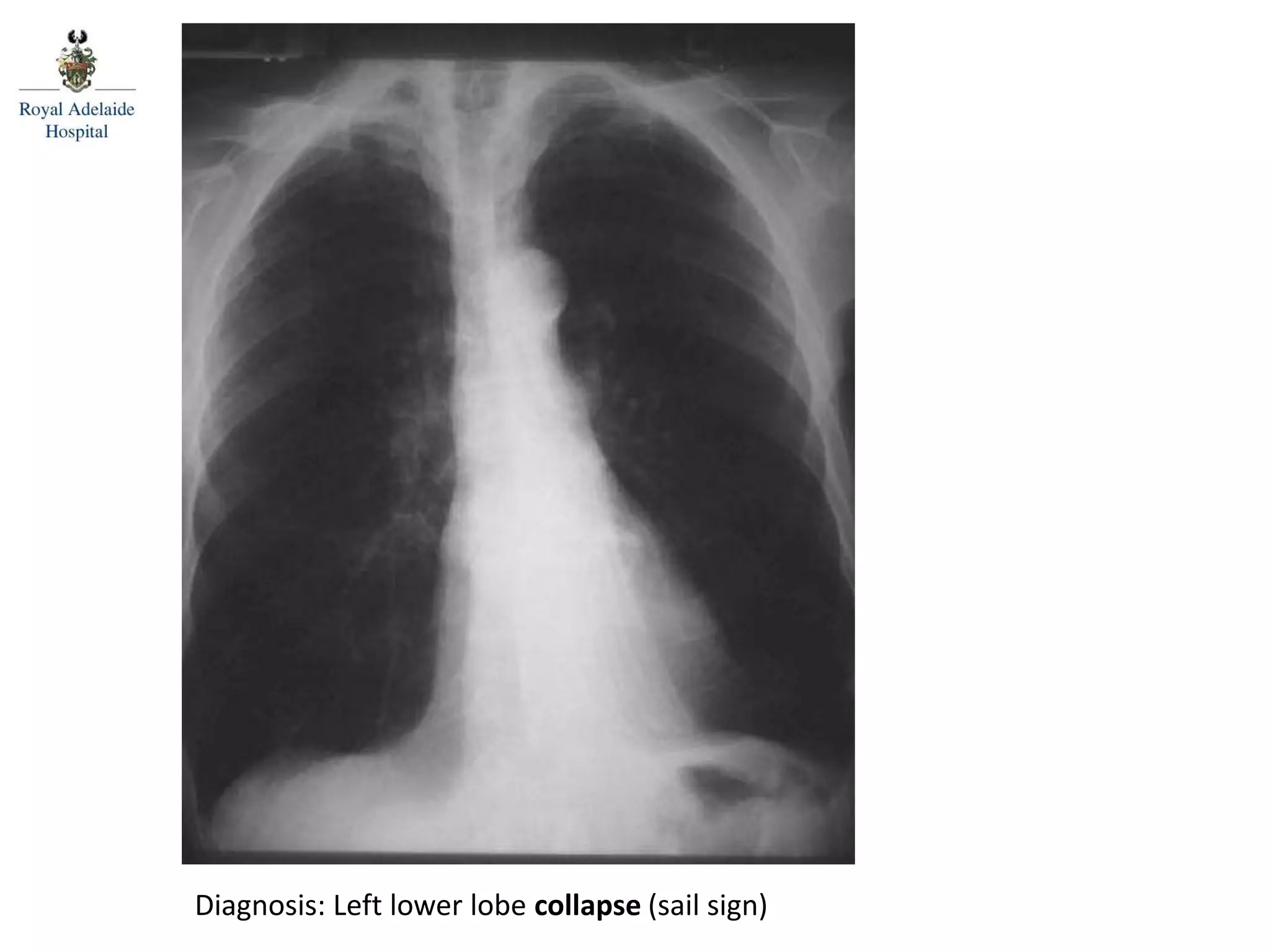 Diagnosis: Left lower lobe collapse (sail sign)
 