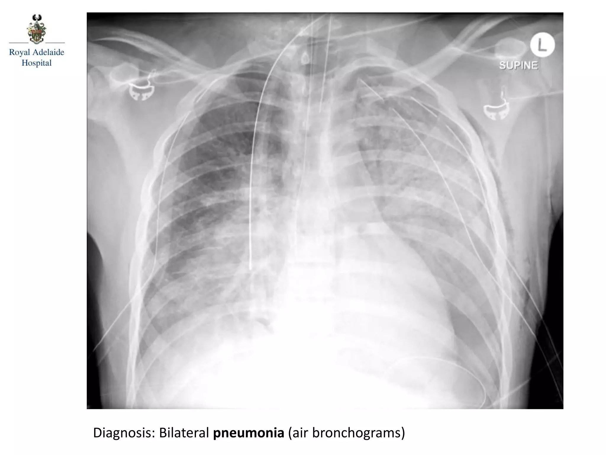 Diagnosis: Bilateral pneumonia (air bronchograms)
 