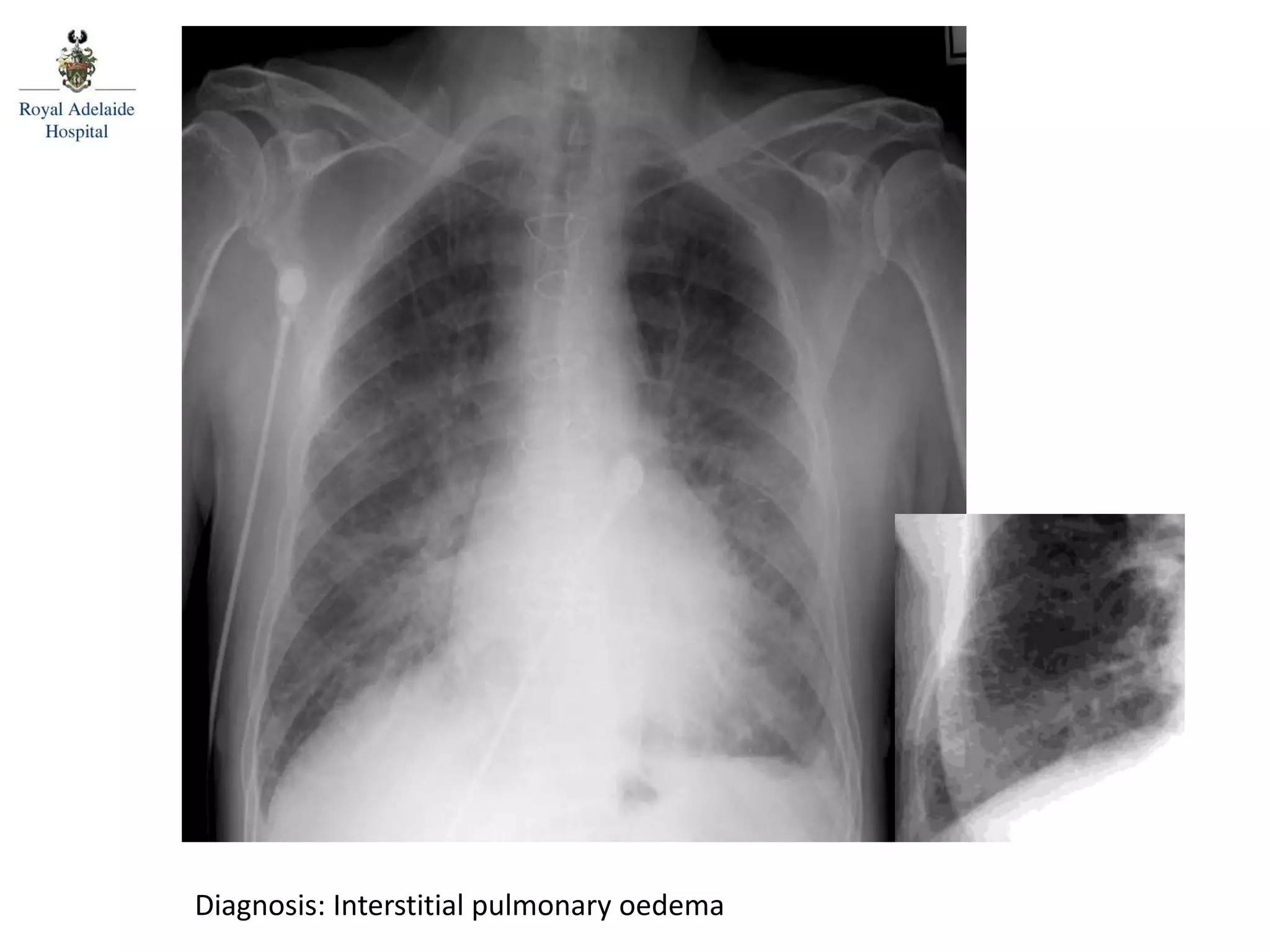 Diagnosis: Interstitial pulmonary oedema
 