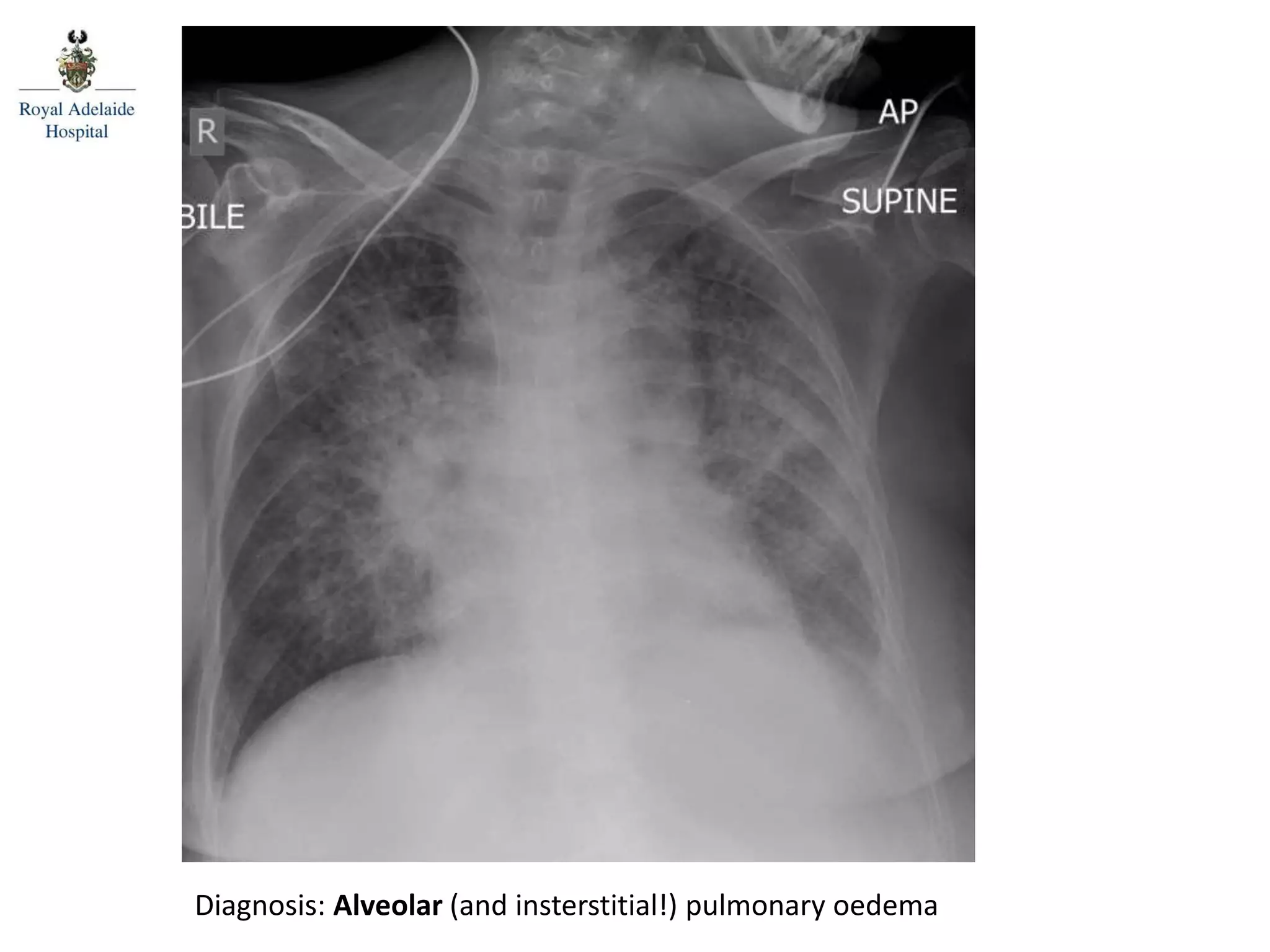 Diagnosis: Alveolar (and insterstitial!) pulmonary oedema
 