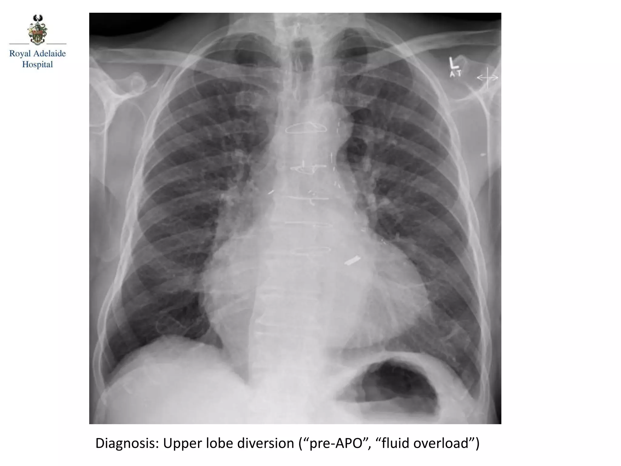 Diagnosis: Upper lobe diversion (“pre-APO”, “fluid overload”)
 