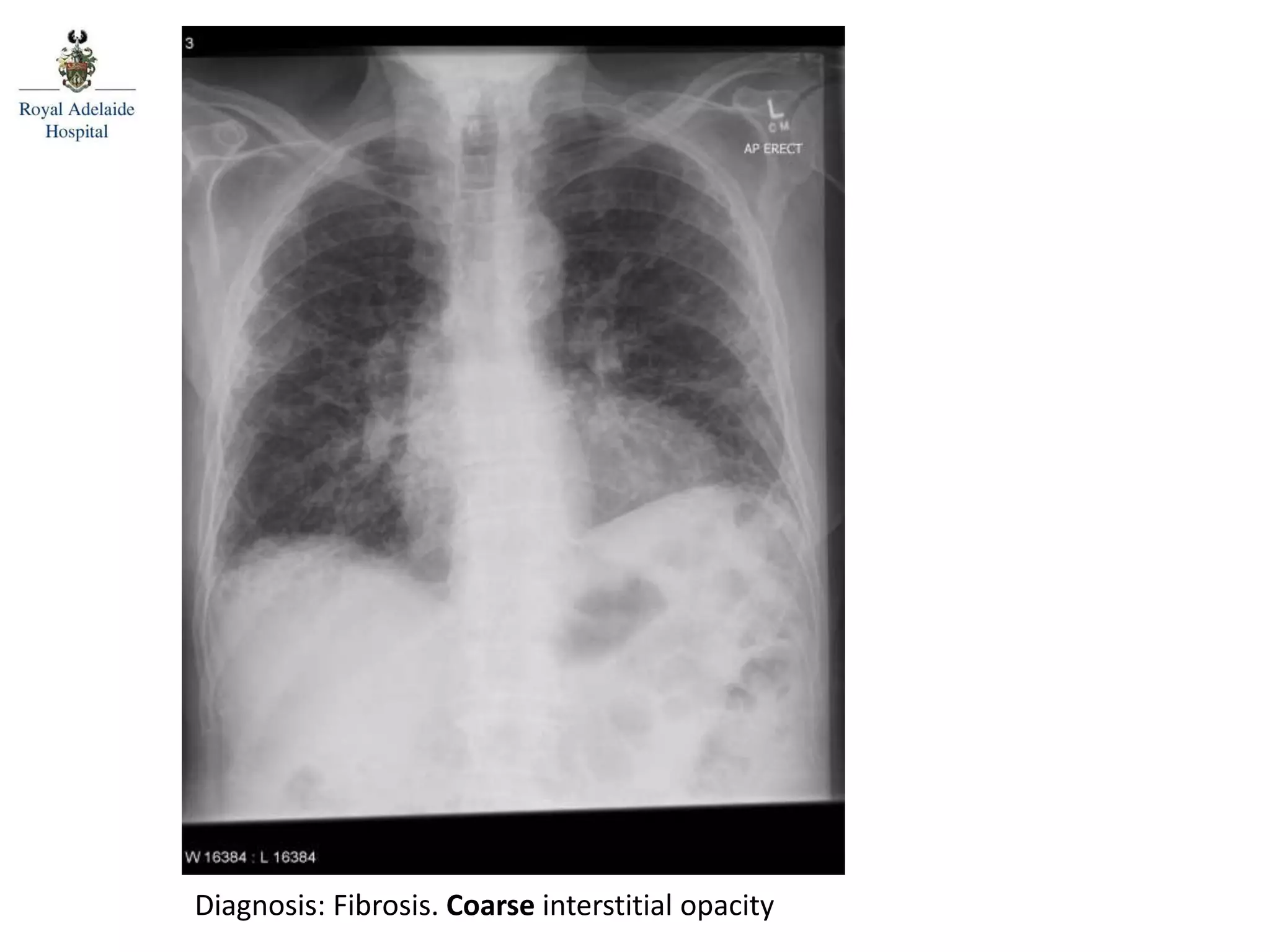 Diagnosis: Fibrosis. Coarse interstitial opacity
 