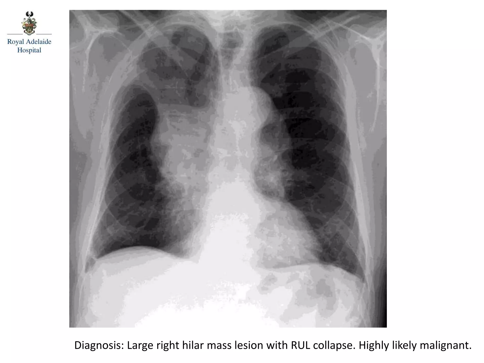 Diagnosis: Large right hilar mass lesion with RUL collapse. Highly likely malignant.
 