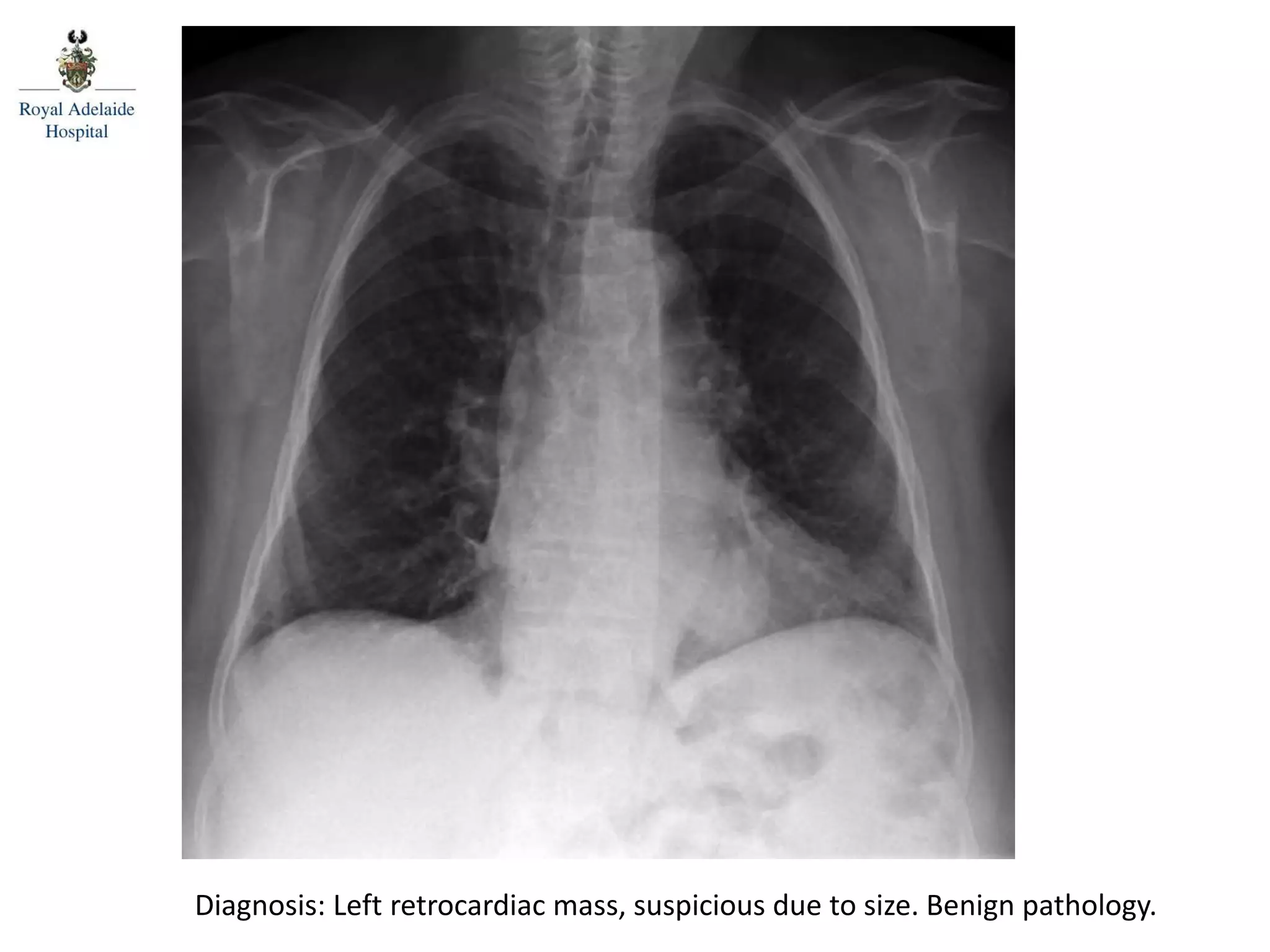 Diagnosis: Left retrocardiac mass, suspicious due to size. Benign pathology.
 